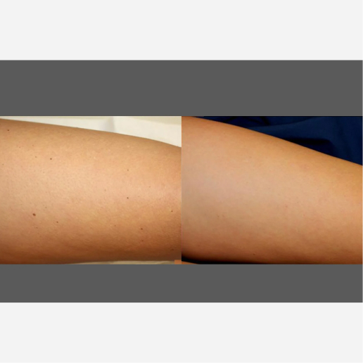 Elite Plus Treatment