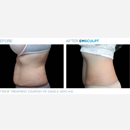 Excessive Weight Gain