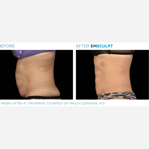 Excessive Weight Gain
