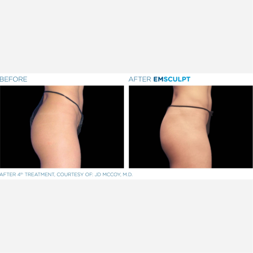 Excessive Weight Gain