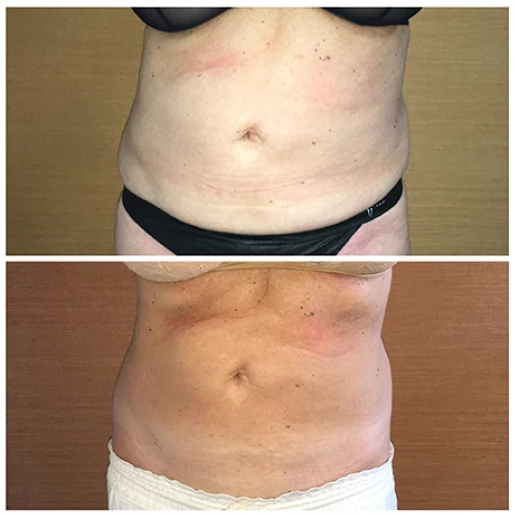 Excessive Weight Gain