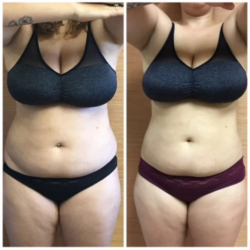 Excessive Weight Gain