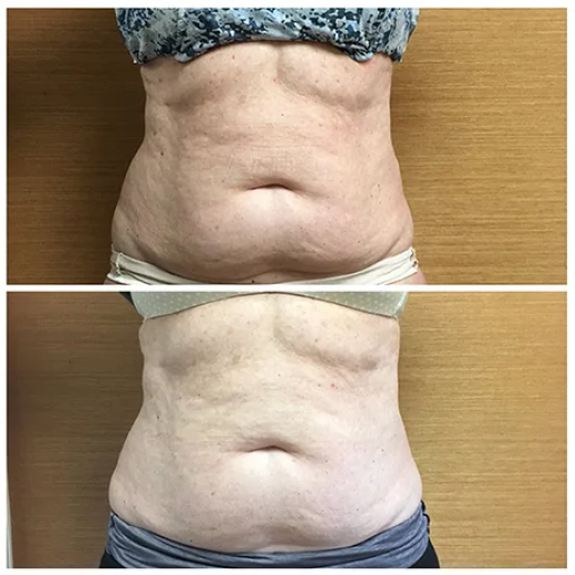Excessive Weight Gain