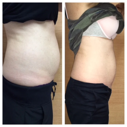 Excessive Weight Gain
