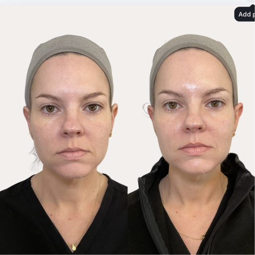 Facial Treatments