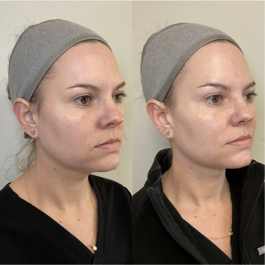 Facial Treatments