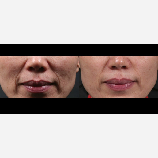 Fusion Facial Treatments