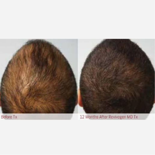 Hair Thinning & Hair Loss