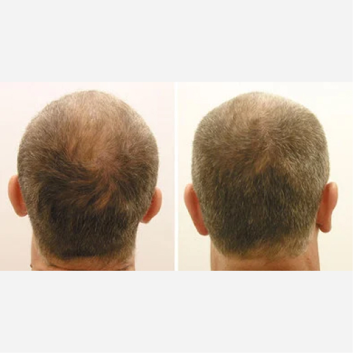 Hair Thinning & Hair Loss