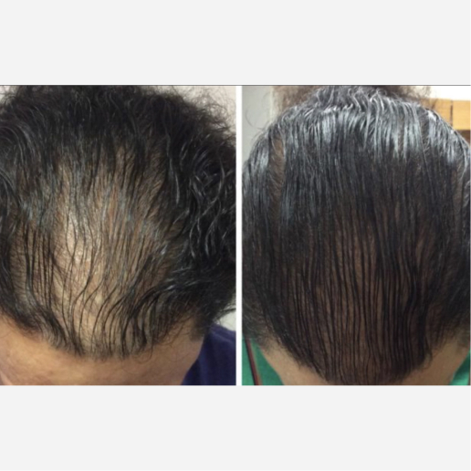 Hair Restoration Treatment
