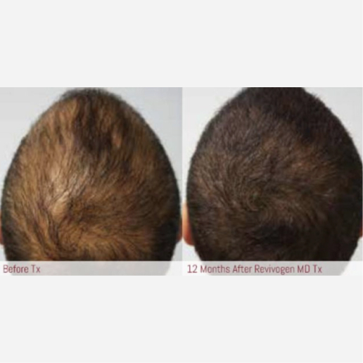 Hair Restoration Treatment