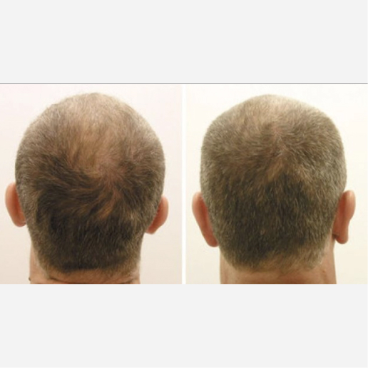 Hair Restoration Treatment
