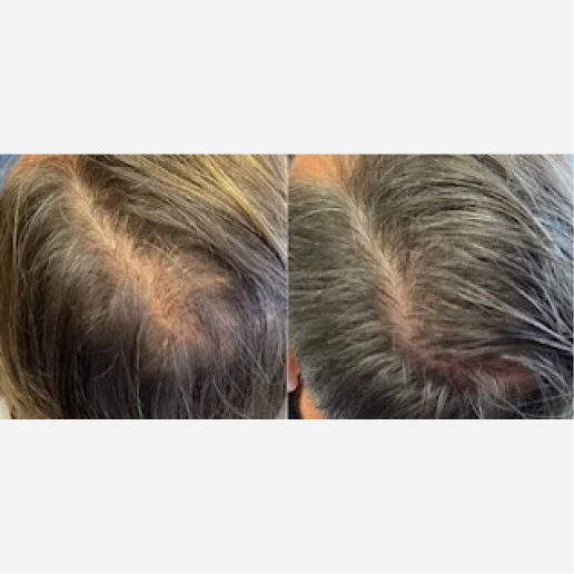Hair Restoration Treatment