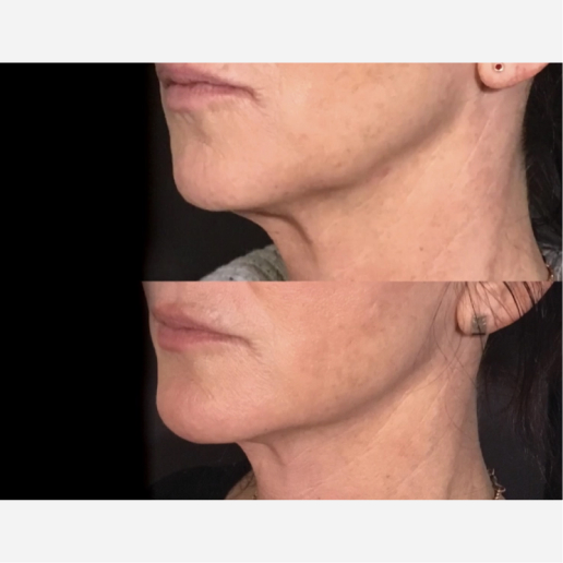 Jawline Contouring Treatment