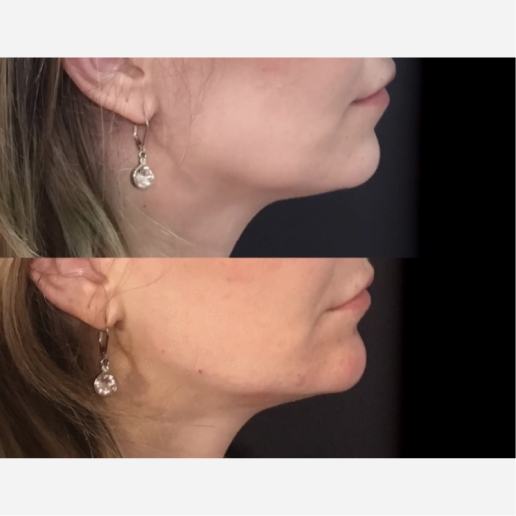Jawline Contouring Treatment