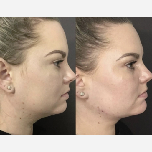 Jawline Contouring Treatment