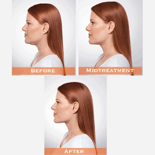 Kybella Treatmen