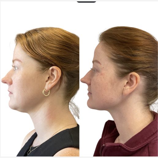 Kybella Treatment