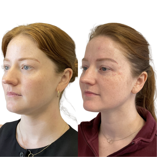 Kybella Treatment