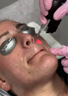 Laser Hair Removal Treatment