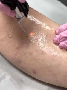 Laser Hair Removal Treatment