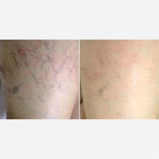 Laser Vein Removal Treatment
