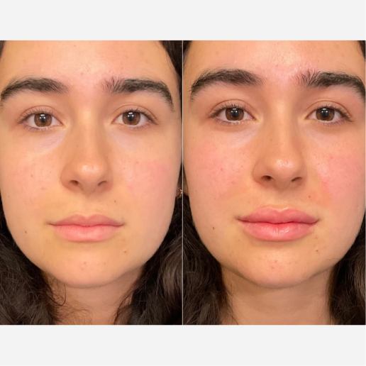 Lip Filler Treatment