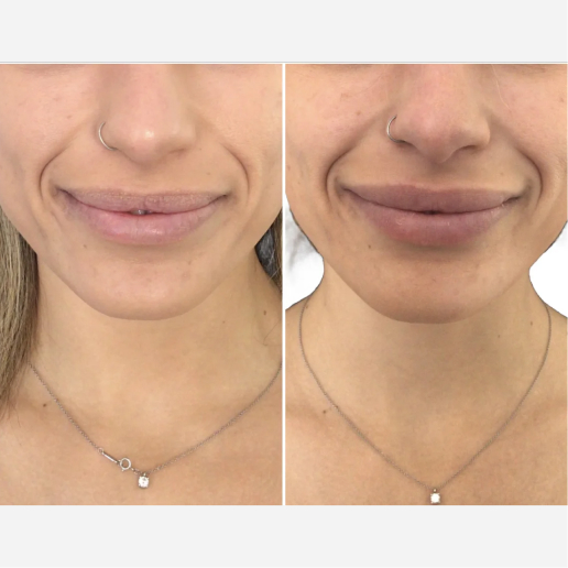 Lip Filler Treatment