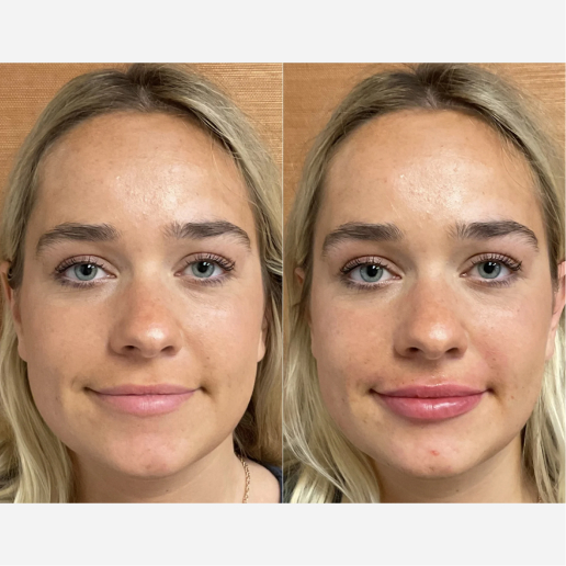Lip Filler Treatment