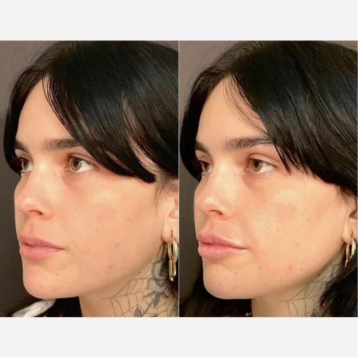 Lip Filler Treatment