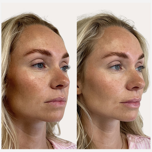 Lip Fillers Treatment