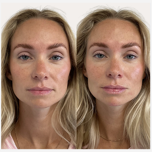 Lip Fillers Treatment