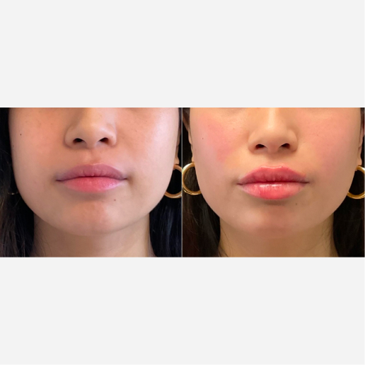 Lip Fillers Treatment