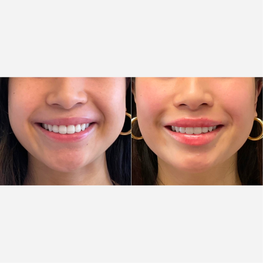 Lip Fillers Treatment