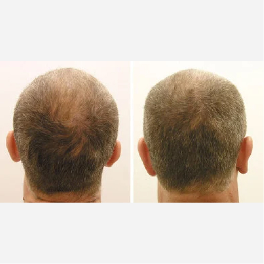 Microneedling Treatment