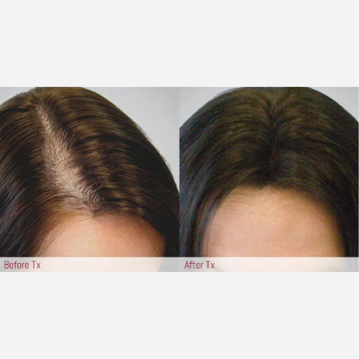 Microneedling Treatment