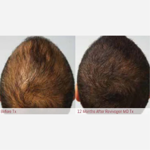 Microneedling Treatment