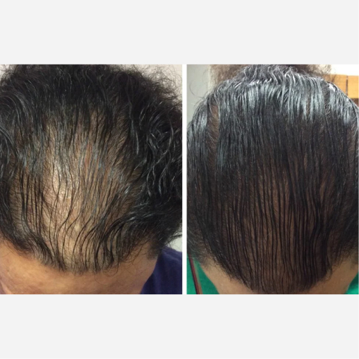 Microneedling Treatment