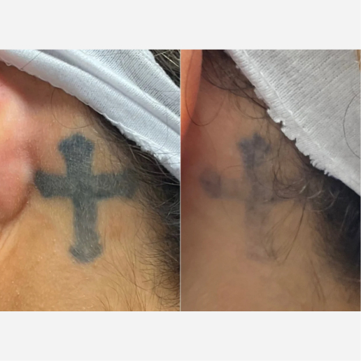 PicoSure Treatment