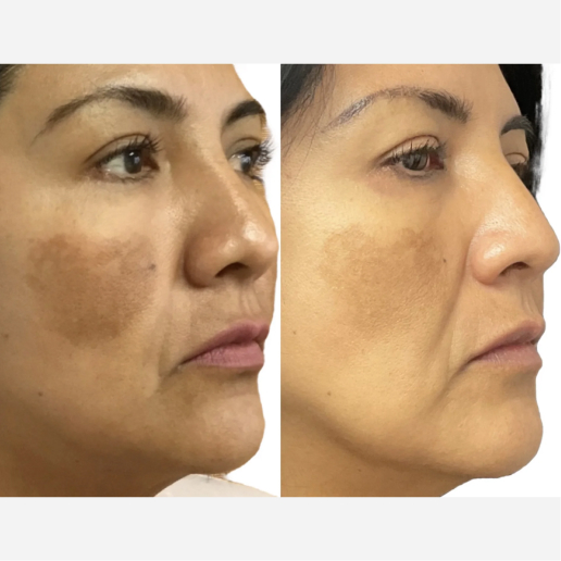 PicoSure Treatment