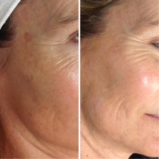 PicoSure Treatment