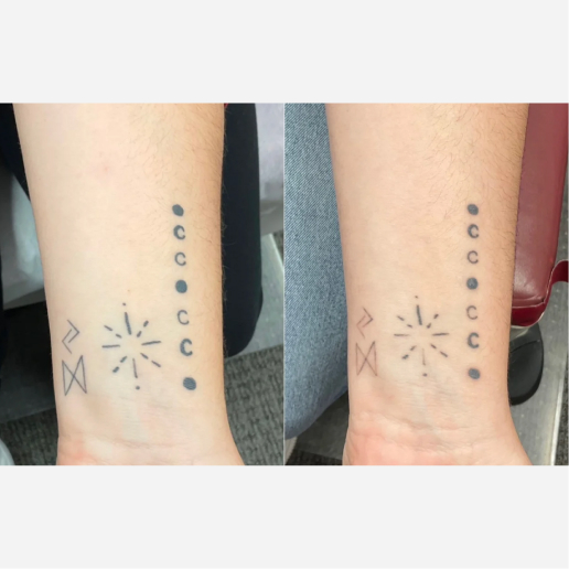 PicoSure Treatment