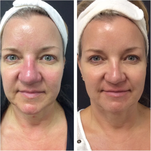 PicoSure Treatment