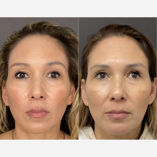 PicoSure Treatment