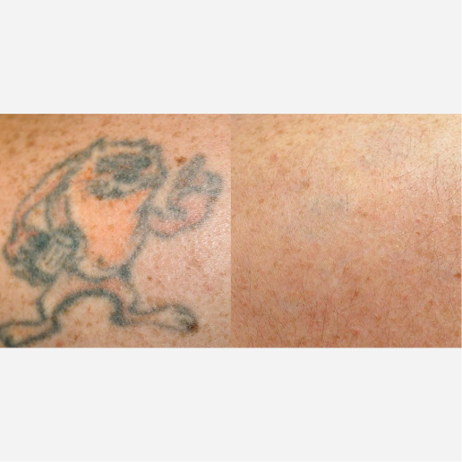 PicoSure Treatment
