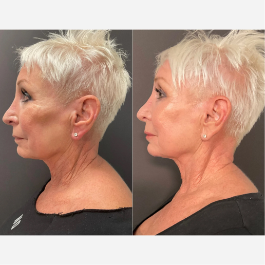 Potenza Microneedling Treatment