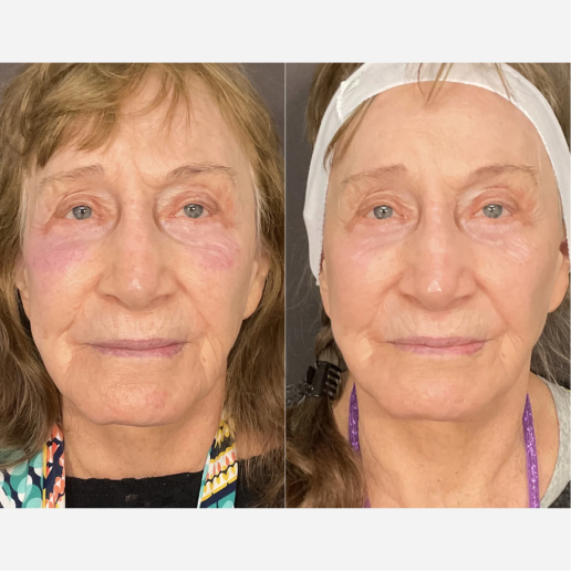 Potenza Microneedling Treatment