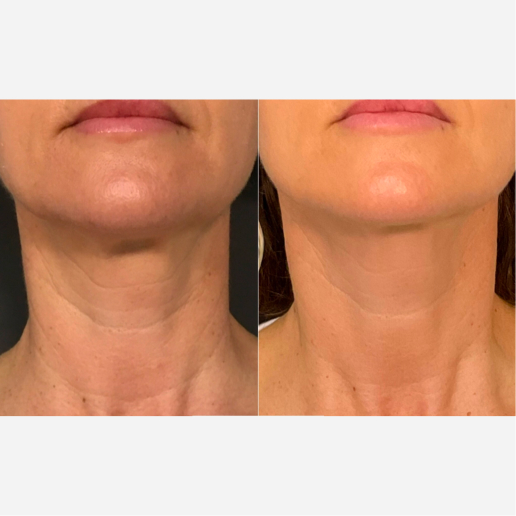 Potenza Microneedling Treatment