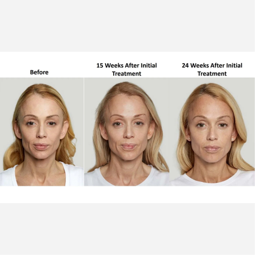 Sculptra Treatment