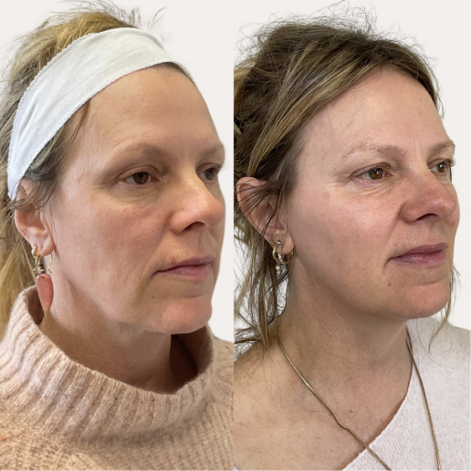 Sculptra Treatment